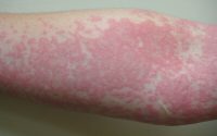 Hives