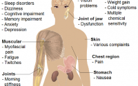 Fibromyalgia