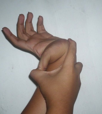 Stock photo showing someone bending their left hand thumb way back with their right hand to demonstrate hypermobility. 