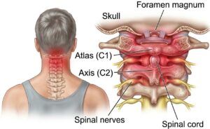An anatomical illustration of the human cervical spine, showing the seven vertebrae that make up the neck. The vertebrae are stacked vertically, forming the upper portion of the spinal column that supports the head and connects to the thoracic spine below.